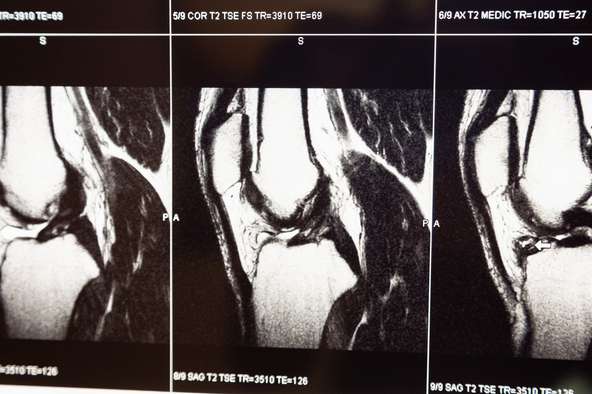 Knee MRI images