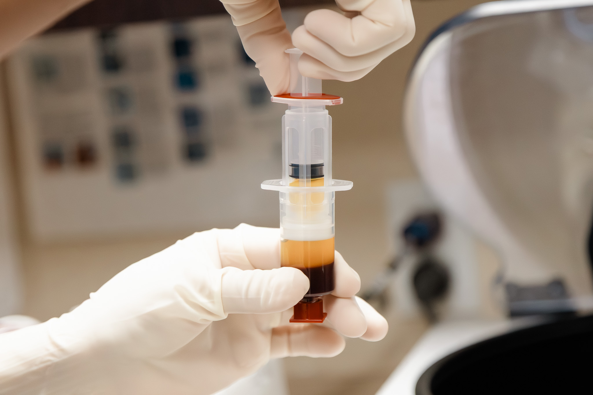Platelet-rich plasma drawn into a syringe